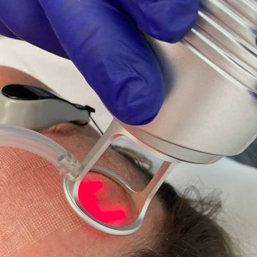 How does CO2 Laser work?